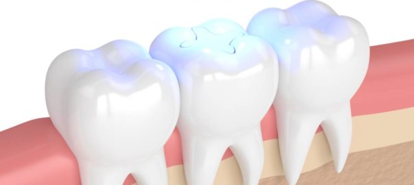 Concept image of color-matched dental fillings