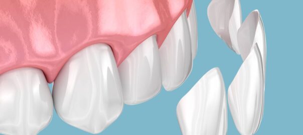 featured image for how to keep your dental veneers clean