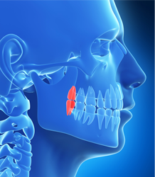 Graphic depicting cutaway of patient skull with dental implants highlighted