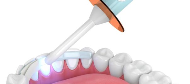 Dental fillings vs dental bondings 3d concept.