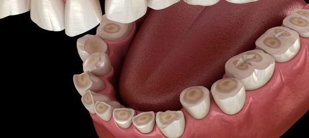 Graphic of bruxism, high angle of lower jaw, teeth are worn down by grinding